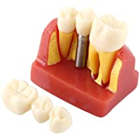 Los mejores  - Resina Dental Demostración Educativa Modelo de diente Análisis de implantes Crown Bridge para dentista Escuela